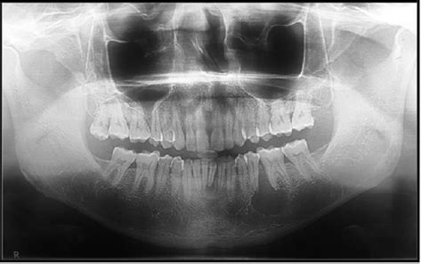 Lateral Keratocyst Of The Posterior Mandible A Case Report