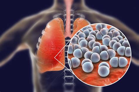 Polmonite Pneumococcica Concetto Medico Illustrazione Di Stock