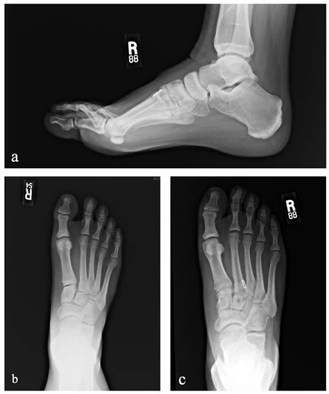 Outcomes Of Lisfranc Injuries Treated With A New Flexible Fixation Technique A Retrospective