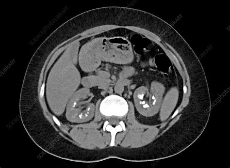 Kidney Stone Cat Scan