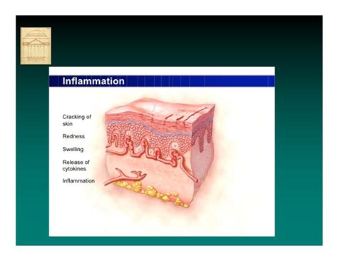 Incontinence Associated Dermatitis by Prof Dr Mikel Gray