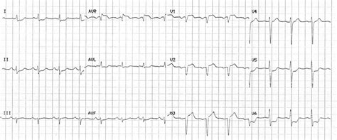 St Elevation In Avr • Litfl • Ecg Library Diagnosis