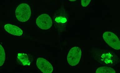 Anti-Centromere Antibody (ACA) and its Significance | Diagnosis ...