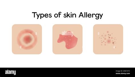 Types Of Skin Allergy Vector Illustration Design Stock Vector Image