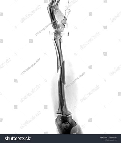 Film Xray Fracture Bone Forearm Stock Photo 2246464053 | Shutterstock