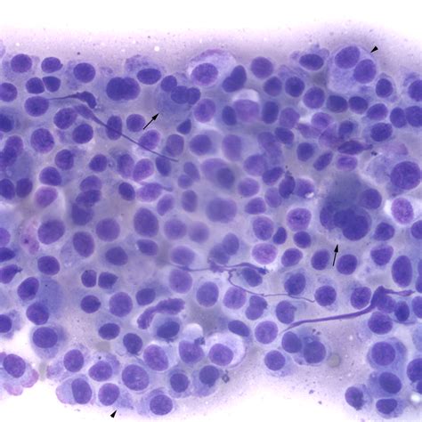 "Discrete" cell tumors | eClinpath