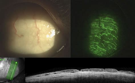 Conjunctival Lymphangiectasia As A Biomarker Of Severe Systemic Disease In Ser77tyr Hereditary