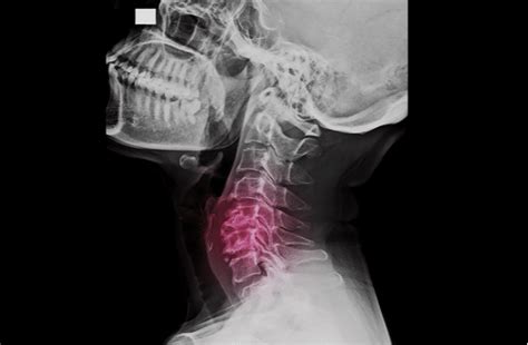 What Can You Do About Cervical Myelopathy Princeton Neurological Surgery