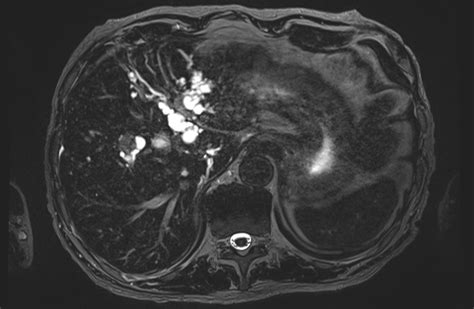 Peribiliary Cysts Image