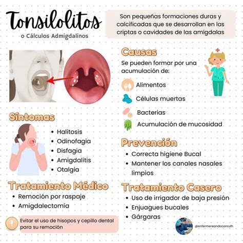 Tonsilolitos C Lculos Amigdalinos Enfermereando Con Ruth Udocz