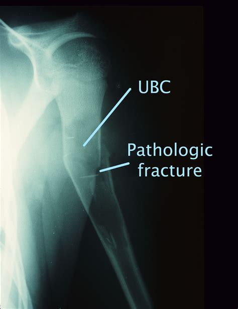 Simple Bone Cyst Mri