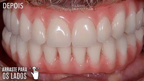 Implante Dent Rio Na Boca Toda Implantes De Dentes Em Todos Os Dentes