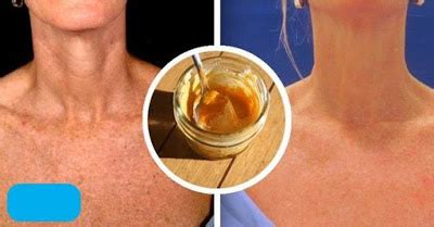 Mascarilla de cúrcuma limón y miel para eliminar las manchas solares y