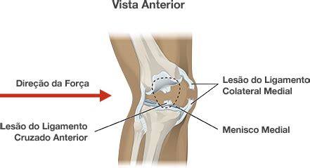 Dr Marcelo Tostes Lesão do Ligamento Colateral do Joelho