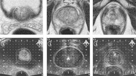 Comparison Of Prostate Volume Shape And Contouring Variability