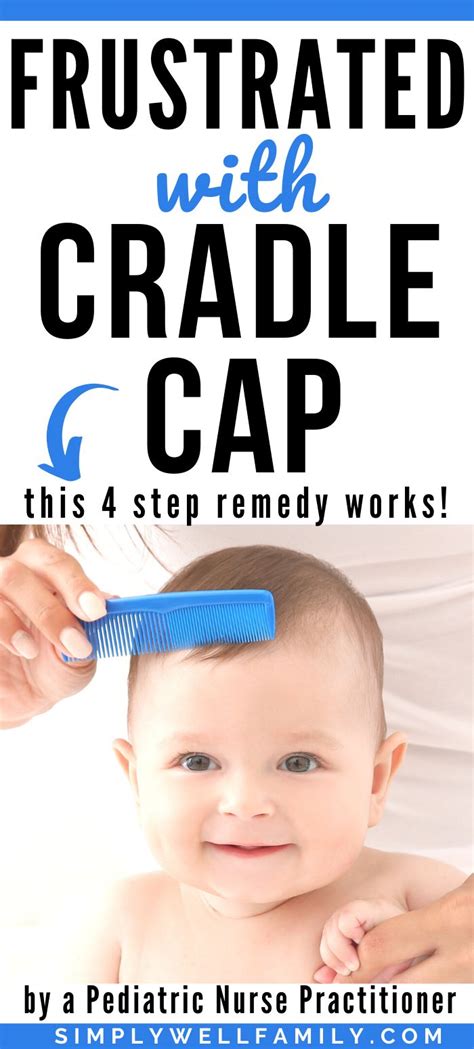 Cradle Cap What Is It And How To Treat It Cradle Cap Parenting