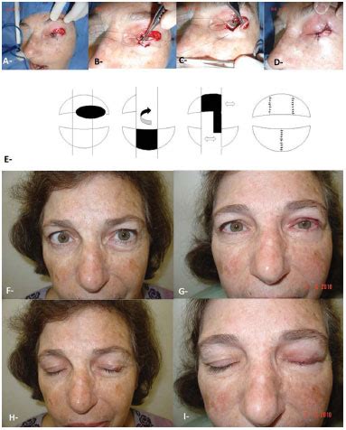 Rbcp Surgical Treatment Of Skin Cancer By The Plastic Surgeon