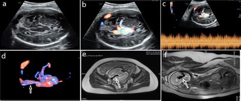 Case 2 30 Week Prenatal Ultrasound And Mri Images Of A Vgam Foetus A