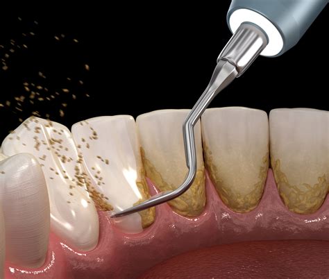 DIENTES CON SARRO, ¿CÓMO QUITARLO? – Estudi Dental Barcelona