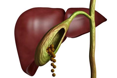 Lithiase Biliaire Et Complications Ccgd Chirurgie Digestive Lyon