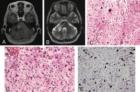 A Axial Postcontrast T1 Weighted Magnetic Resonance Imaging Mri