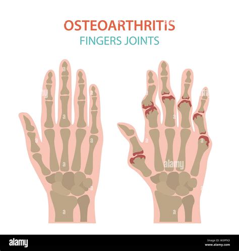 Arthritis Osteoarthritis Medical Infographic Design Joint Replacement