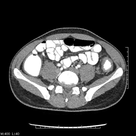 Radiopaedia Case Ulcerative Colitis Id Study Nc Commons