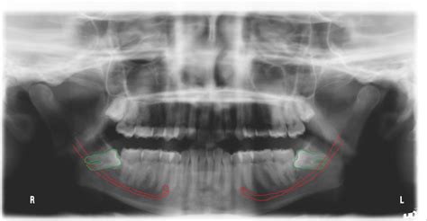 Odontotomia Del Dente Del Giudizio E Nervo Alveolare Inferiore Dott