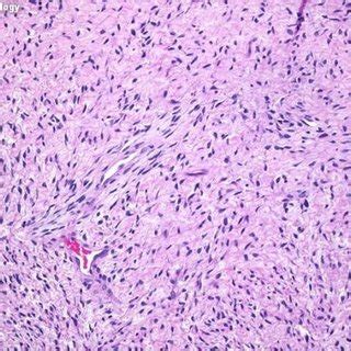 Histology of CIFS showing fascicles of round to spindle cells with ...