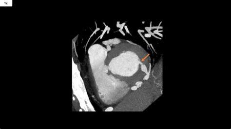 Coronary Cameral Fistula Siemens Healthineers Vietnam