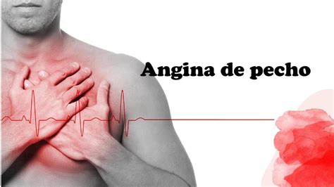 Angina De Pecho Katherigne Urueta UDocz