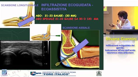 Infiltrazione Del Gomito Ecoguidata Quando Usare Lacido Ialuronico