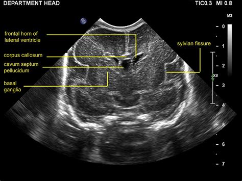 Practical Guide To Neonatal Cranial Ultrasound Crus Basics