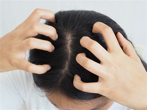 Scalp Eczema: Symptoms, Causes & Treatment - K Health