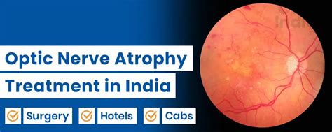 Optic Nerve Atrophy Treatment in India - Costs, Top Surgeons & Advanced ...