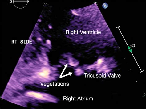 Two Dimensional Echocardiogram Image Demonstrates Two Echogenic