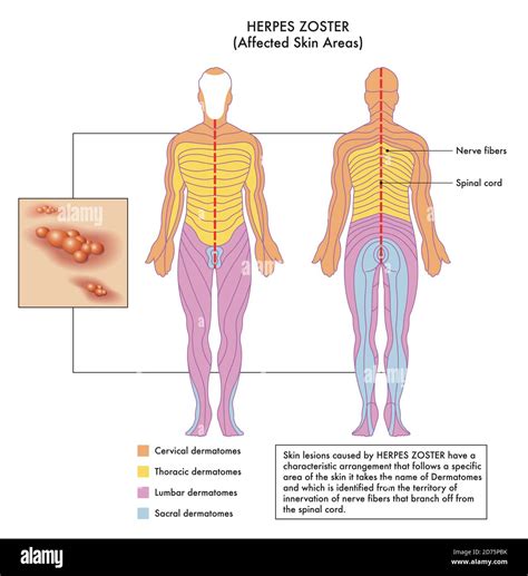 Dermatome Map And Shingles