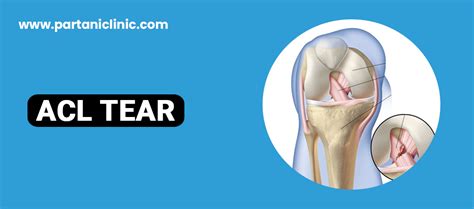 ACL Tear Surgery in Jaipur | ACL Reconstruction | Dr. Arun Partani