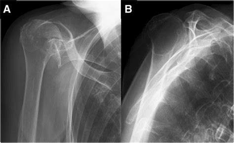 X-ray radiography images demonstrating the right humeral head... | Download Scientific Diagram