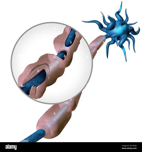 Multiple Sclerosis Diagram Concept Or Ms Autoimmune Disease Anatomy With Healthy Nerve And