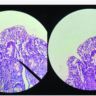 Endoscopic View Of Duodenal Mucosa And Bleeding After Biopsy