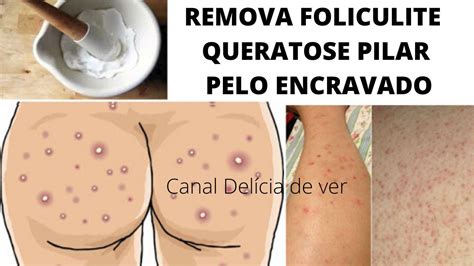 Como Acabar A Foliculite Pelo Encravado E Queratose Pilar Top