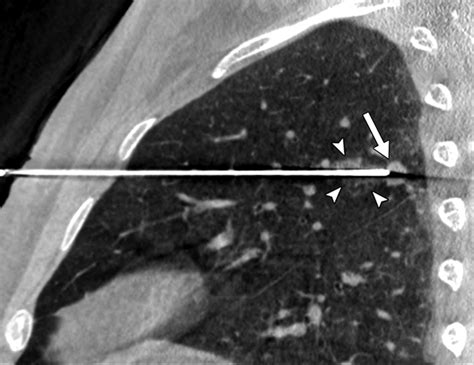 C Arm Cone Beam Ct Guided Percutaneous Transthoracic Needle Biopsy Of