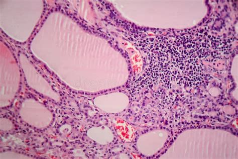 Histopathology Of Endemic Goitre Stock Photo Image Of Anatomical