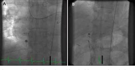 Figure 3 From Treating Coronary Artery Fistulas And Pulmonary Avms