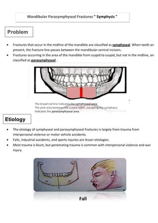 Symphysis & Angle MANDIBULAR FRACTURES | PDF