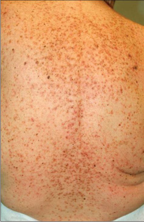 Cutaneous Toxicity Of A New Braf Inhibitor Lgx Encorafenib