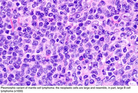 Pathology Outlines Mcl Aggressive Variants