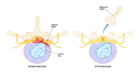 Lumbar Laminectomy for Lower Back Pain - SpineMed Specialists