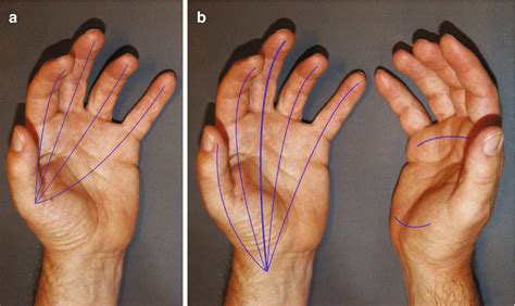 Gross Anatomy Of The Human Hand Springerlink